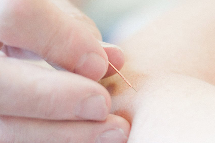 Acupuncture Services in Coventry